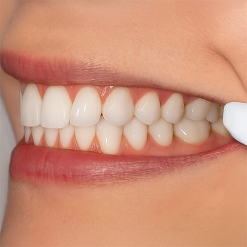 Virtual Consultation Smile Image Example - Left Bite