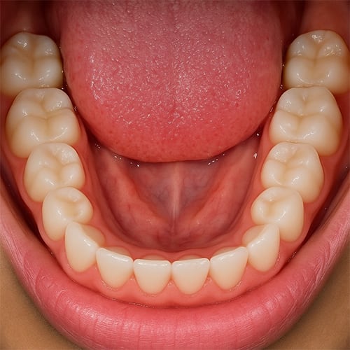 Virtual Consultation Smile Image Example - Lower Arch